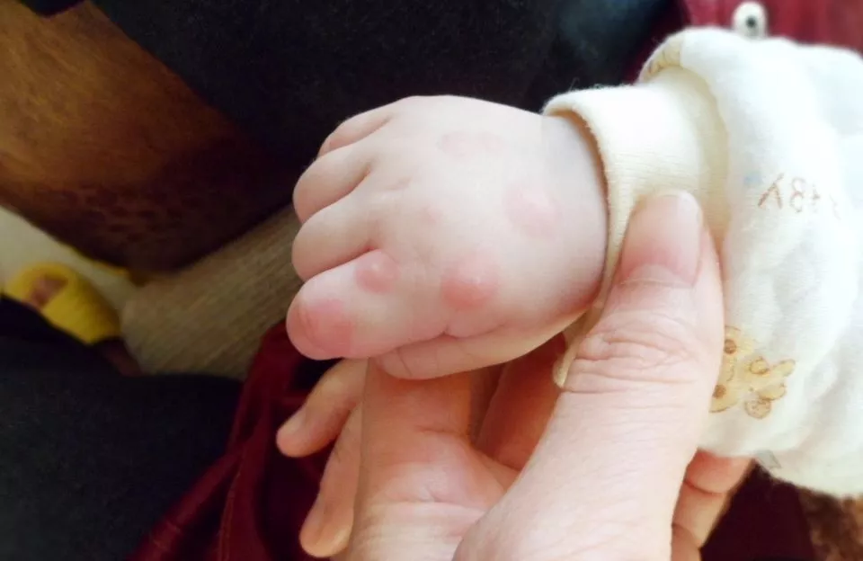 手足口病“高峰年”寶媽如何做預(yù)防