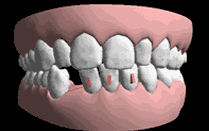 矯正牙齒后牙齒會松？矯正器表示這個黑鍋我不背