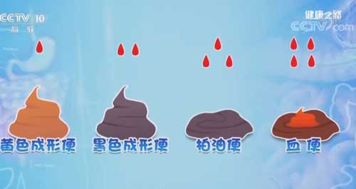 沒有喝咖啡,嘔吐物卻是咖啡色!警惕這是胃出血