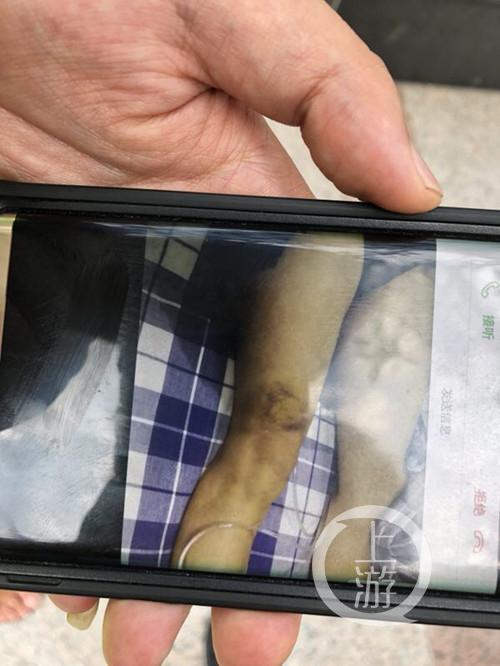 醫(yī)生安穎彥腿上的傷痕。