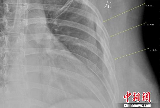 女白領(lǐng)咳斷3根肋骨不良生活習慣致骨質(zhì)疏松