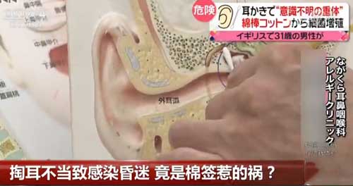 掏耳不當致感染昏迷 竟是棉簽惹的禍?