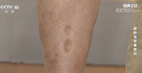 【名醫(yī)話健康】腿腫一摁一個坑？小心是致命的深靜脈血栓！